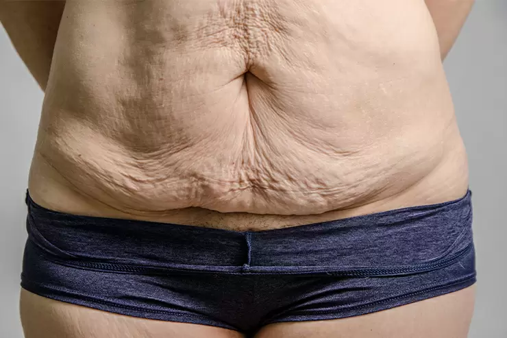 Cirurgia para Retirada de Sobras de Pele Após a Bariátrica – Um Direito Garantido